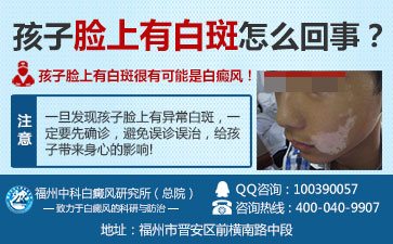 得白癜风的病因是什么