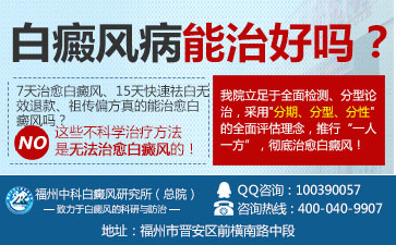 白癜风治疗,白癜风常识