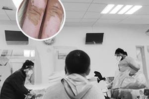 308后发红还能涂他克莫司吗