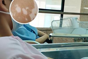 白癜风光疗后又变红多久能恢复