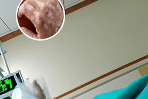 白癜风皮肤镜影像检查