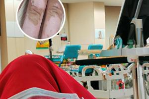 卤米松软膏擦多久就要停