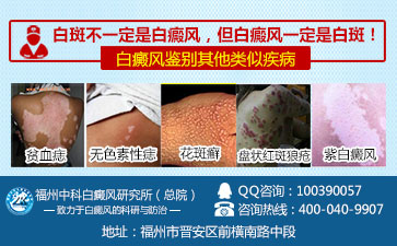 白癜风症状,白癜风常识